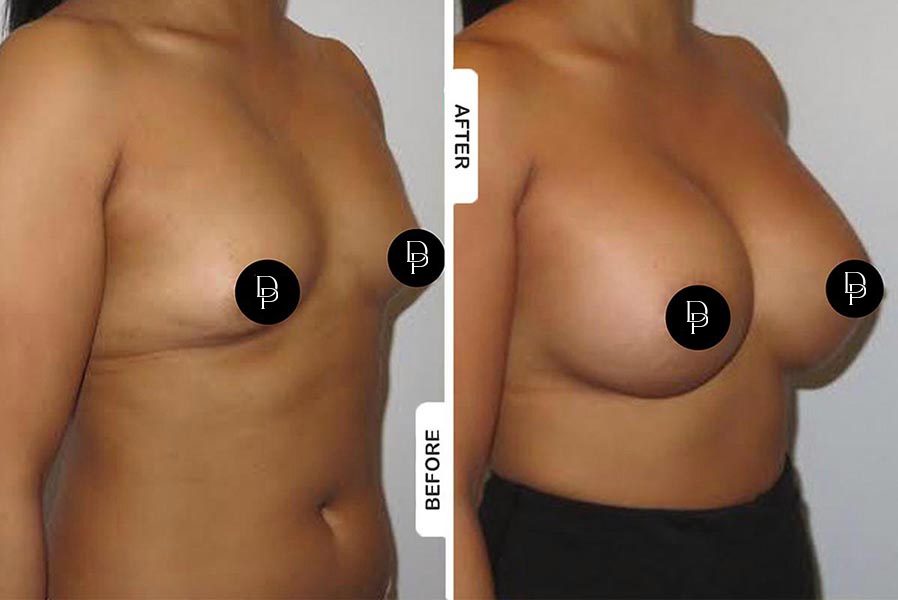 breast-augmentation_1