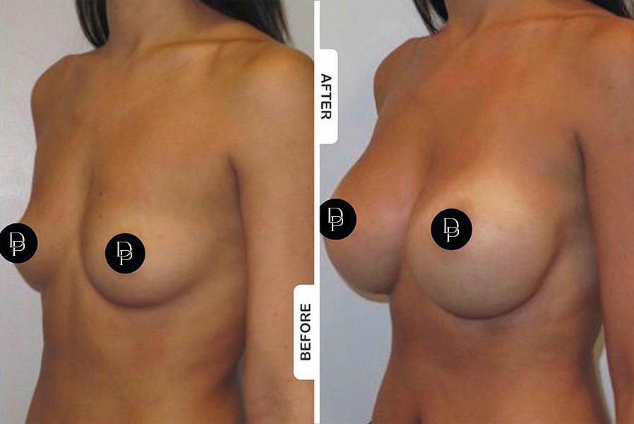 breast-augmentation_2
