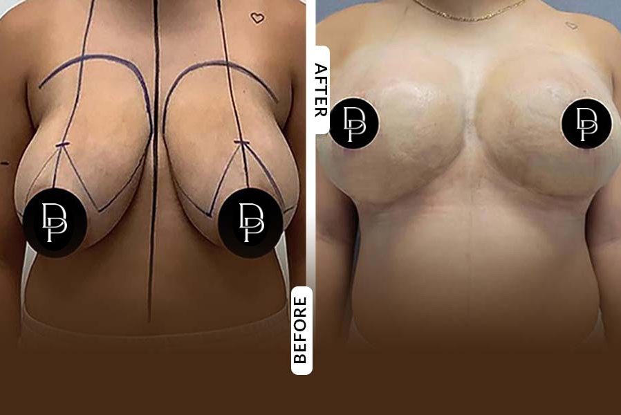 breast-reduction_2